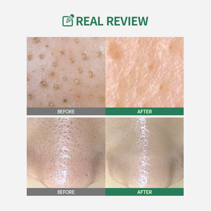 Pore Intensive Care Set